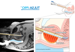 Pivotal Study of MRI-guided Transurethral US Ablation to Treat Localized Prostate Cancer
