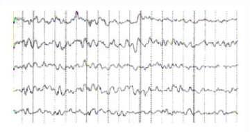 正常脑电图