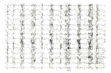 癫痫脑电图