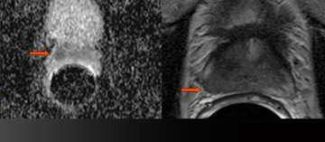 MRI显示的囊外延伸和精囊侵犯